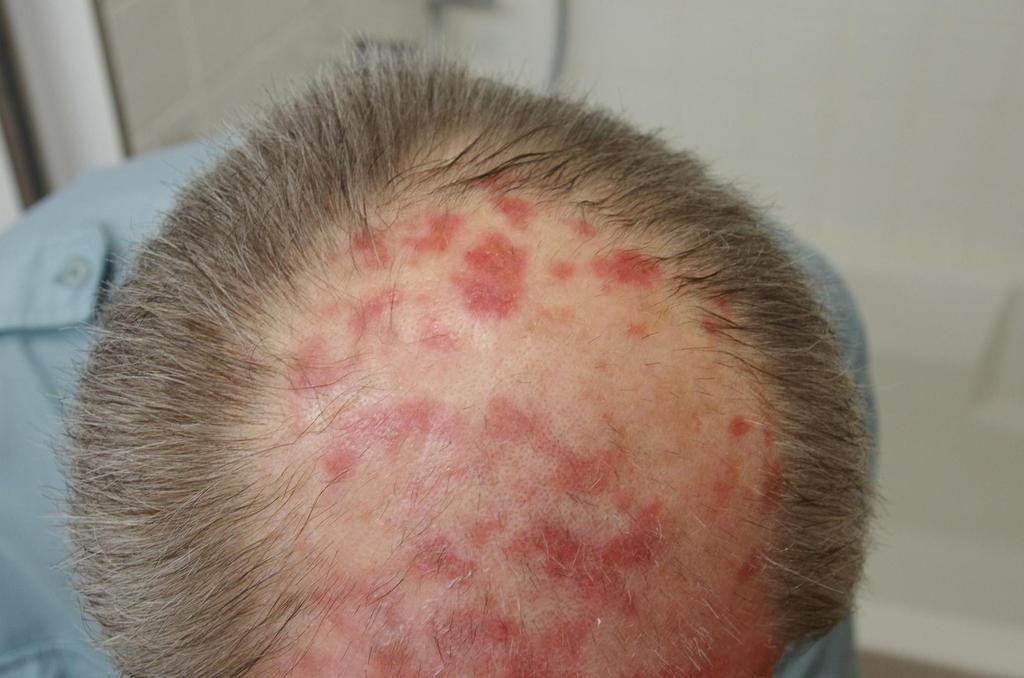 Actinic Keratosis Treatment Efudix Actinic Keratosis Treatment Efudix