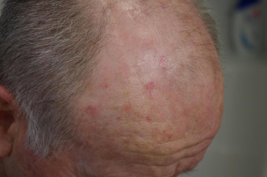 Actinic Keratosis Treatment Efudix Actinic Keratosis Treatment Efudix