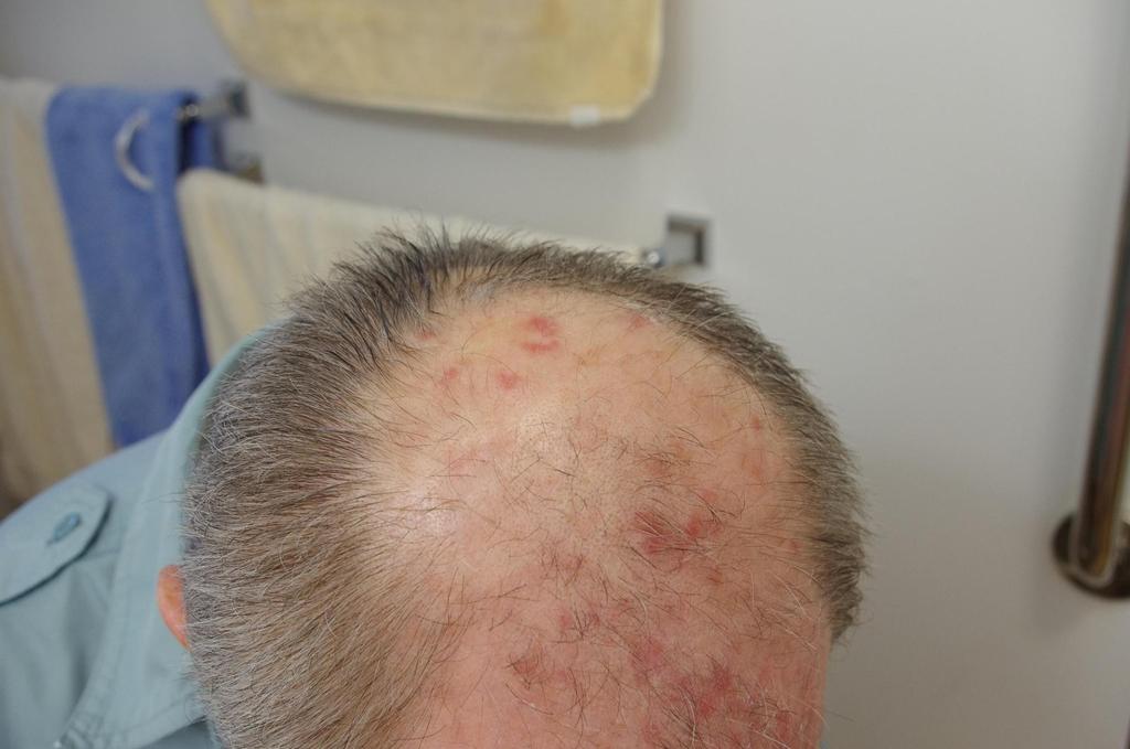 Actinic Keratosis Treatment Efudix Actinic Keratosis Treatment Efudix